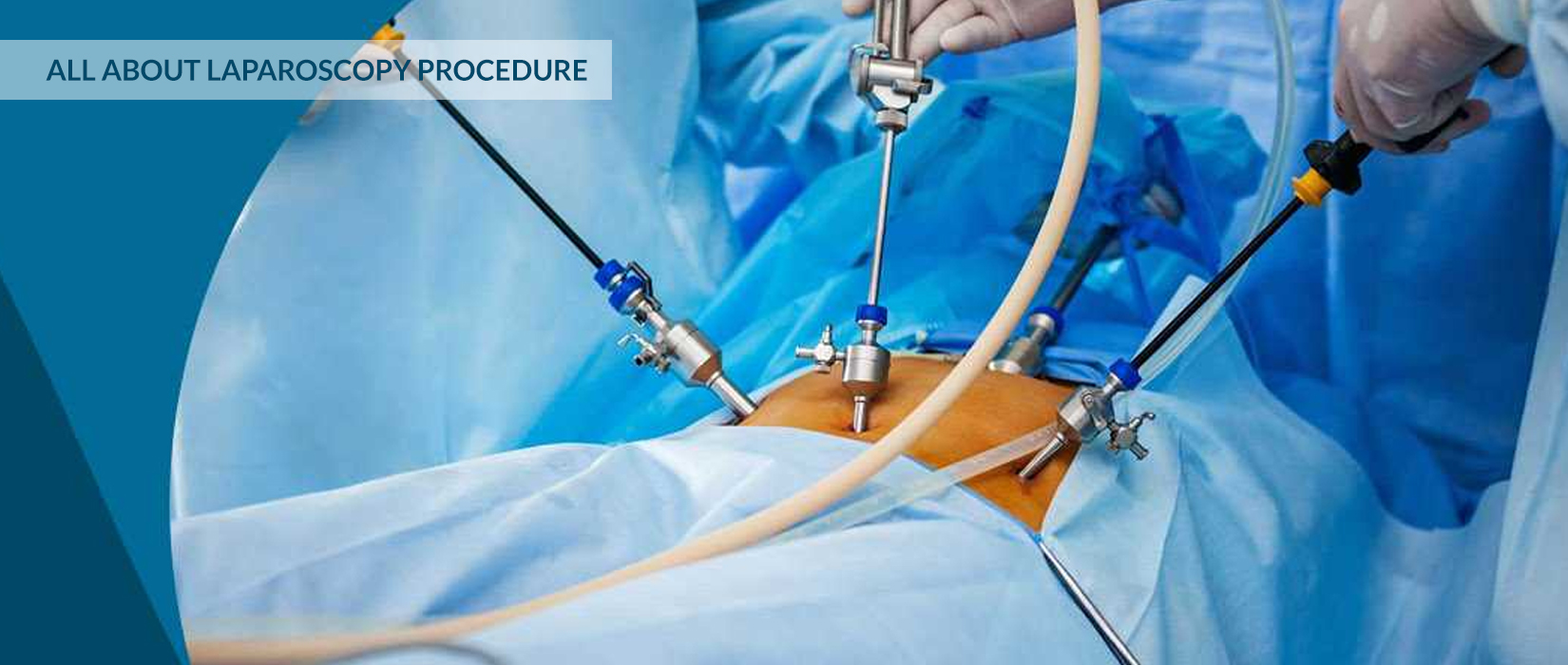Laparoscopic Surgery
